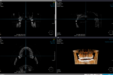 La diagnosi odontoiatrica tramite la TC Cone Beam