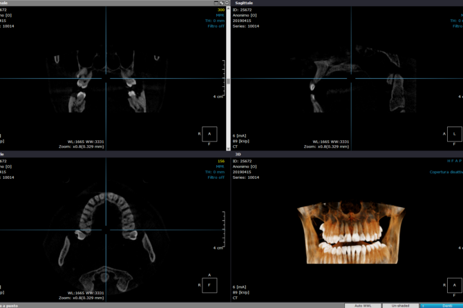 La diagnosi odontoiatrica tramite la TC Cone Beam